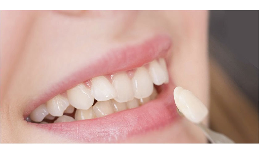 Ưu, nhược điểm của dán răng sứ không mài răng