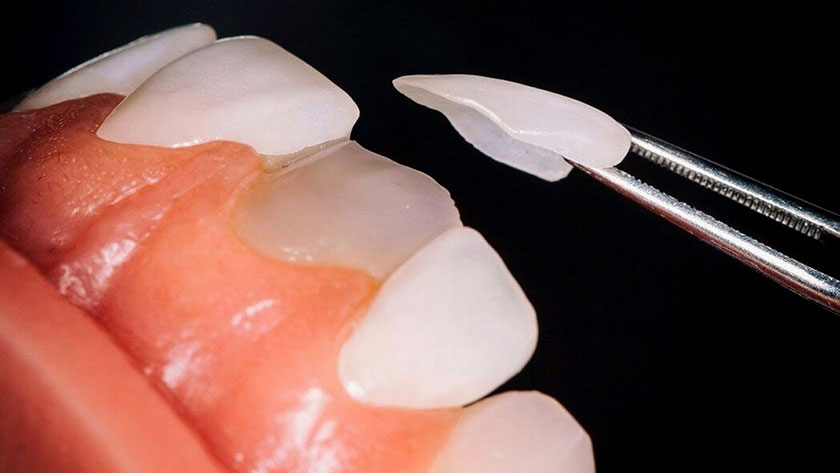 Mặt dán sứ Veneer yêu cầu mài răng khá ít