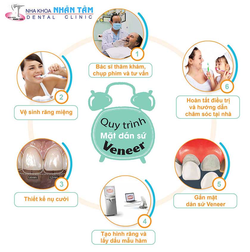 quy trình mặt dán sứ veneer