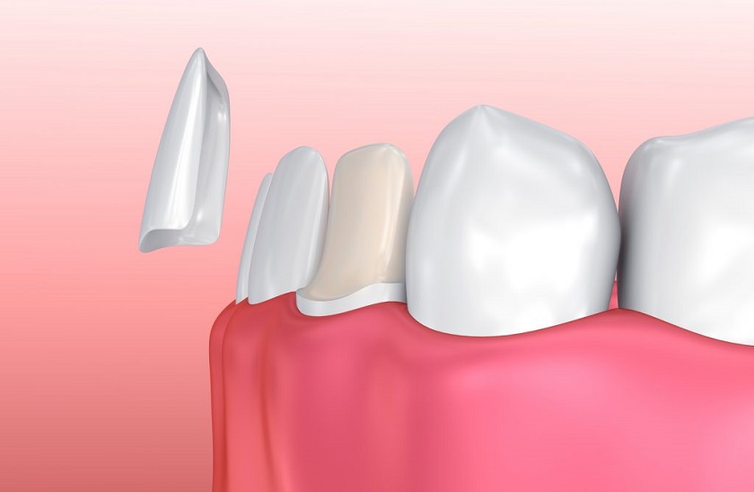 Miếng dán sứ Veneers