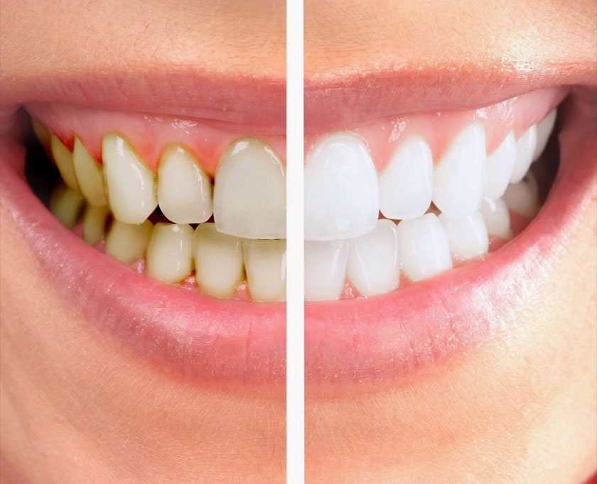 Bọc răng sứ khắc phục tình trạng răng xỉn màu