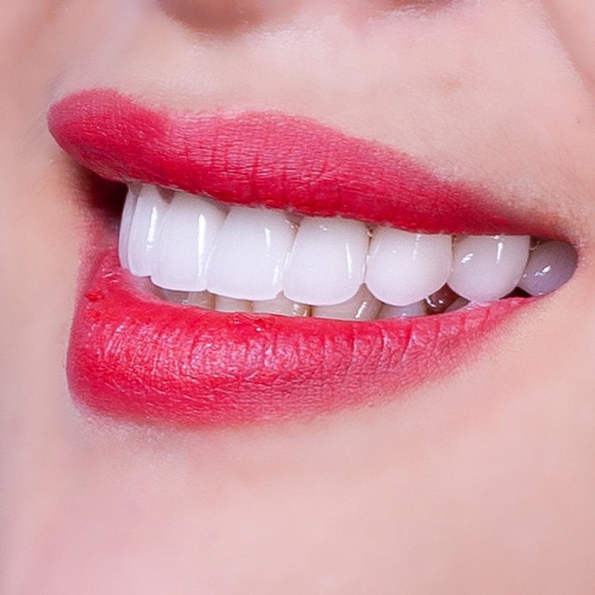 Tuổi thọ răng sứ chịu tác động của nhiều yếu tố