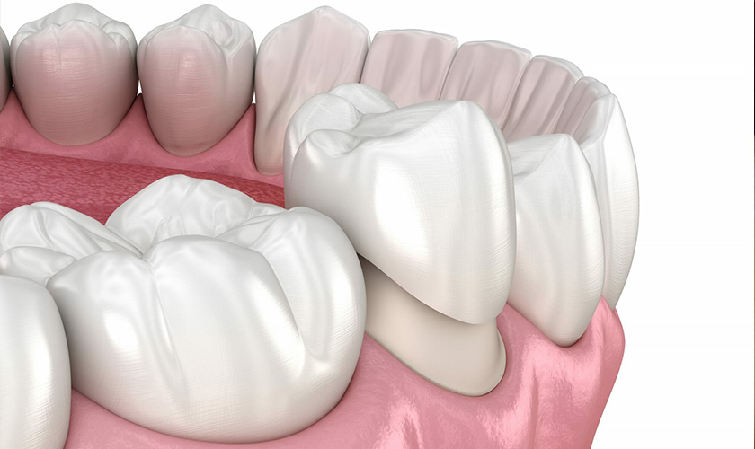 Bọc răng sứ thẩm mỹ có hại không? Bọc răng sứ thẩm mỹ có hại không?