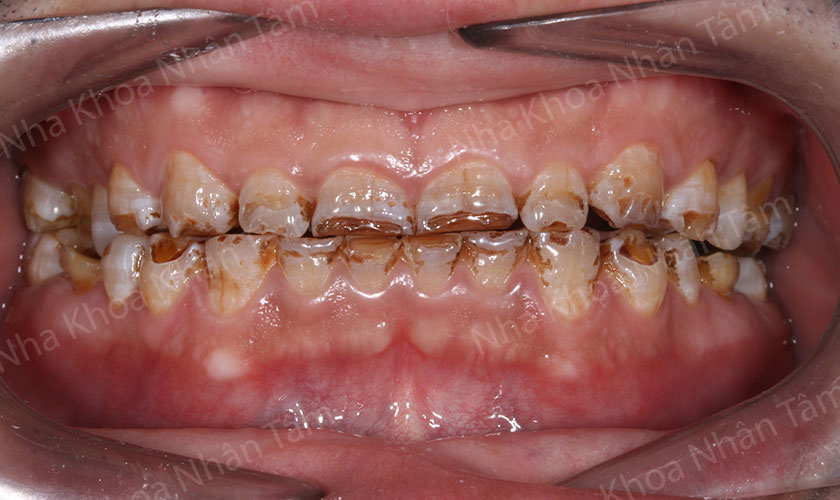 Răng bị nhiễm màu nặng không thể tẩy trắng thì có thể khắc phục bằng bọc răng sứ