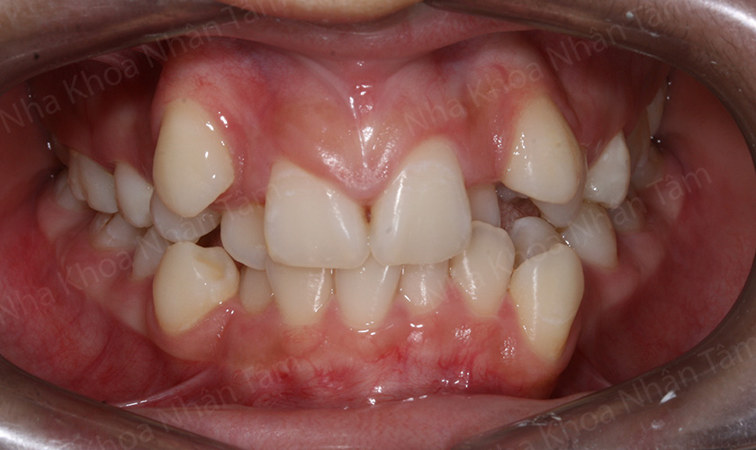 Răng mọc chen chúc, lệch lạc quá nhiều nên thực hiện niềng răng