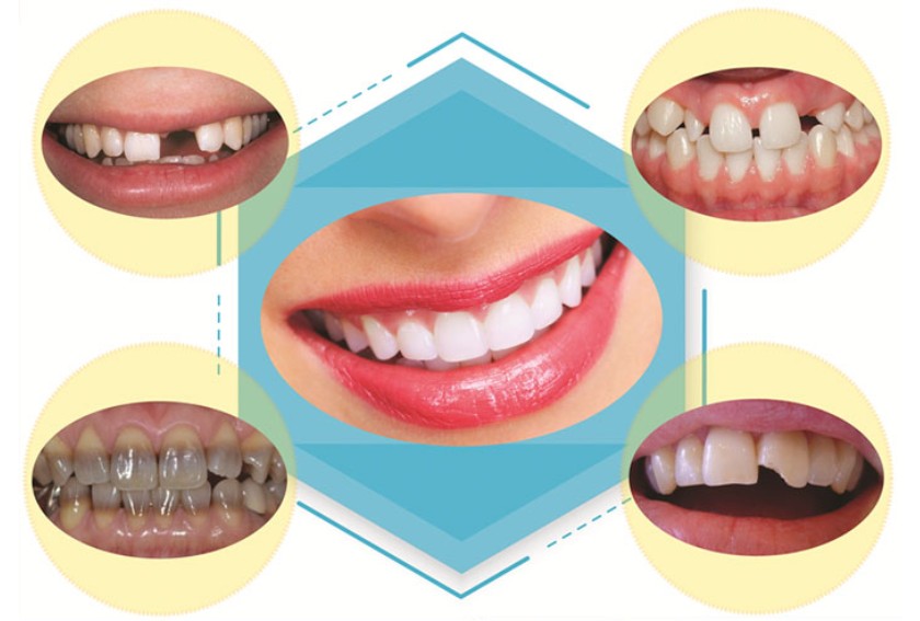 Răng sứ thẩm mỹ phù hợp với nhiều trường hợp răng sạm màu, gãy, vỡ, mất răng...