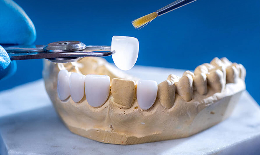 Mặt dán sứ Veneer được rất nhiều người ưa chuộng