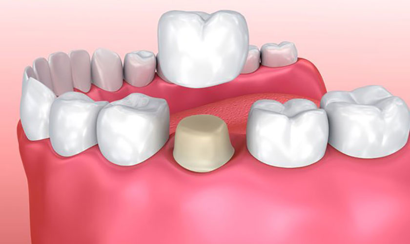 Có nên bọc răng sứ cho răng sậm màu?