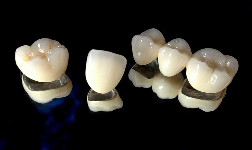 Răng sứ kim loại có khung sườn được làm bằng kim loại và bên ngoài được bao phủ bởi lớp sứ