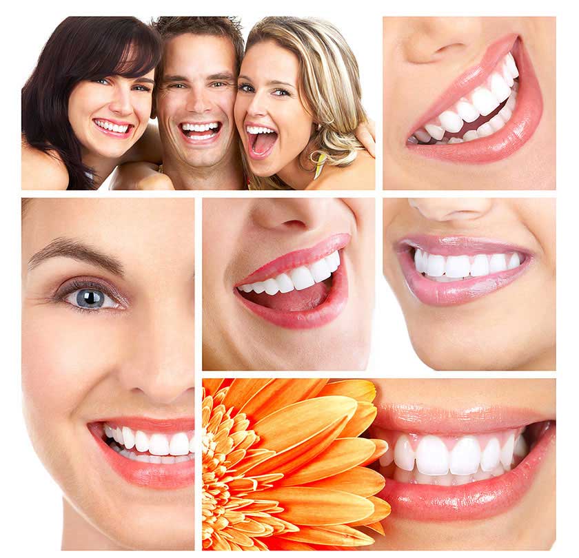 Răng veneer - giải pháp cho nụ cười hoàn hảo