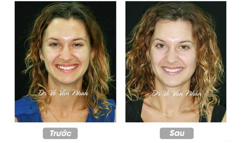 Khách hàng trước và sau khi làm răng sứ tại nha khoa Nhân Tâm