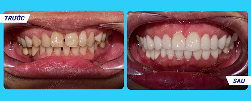 Khách hàng điều trị răng sứ tại Nha khoa Nhân Tâm