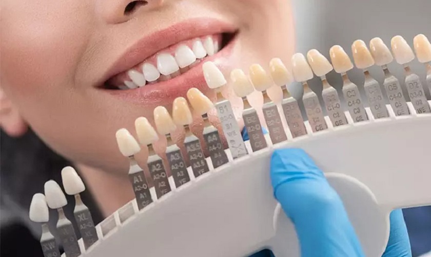 Giải đáp băn khoăn: Bọc răng sứ được bao lâu?