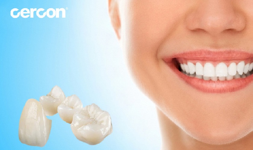 Những điều cần biết về răng sứ Cercon