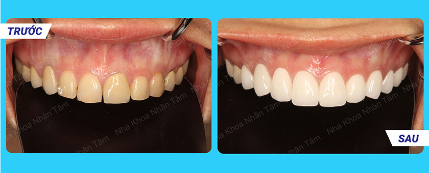 Mặt dán sứ điều trị các khiếm khuyết của răng