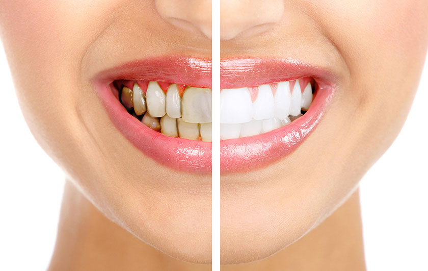  Khách hàng bọc răng sứ khắc phục tình trạng răng lệch và nhiễm kháng sinh 