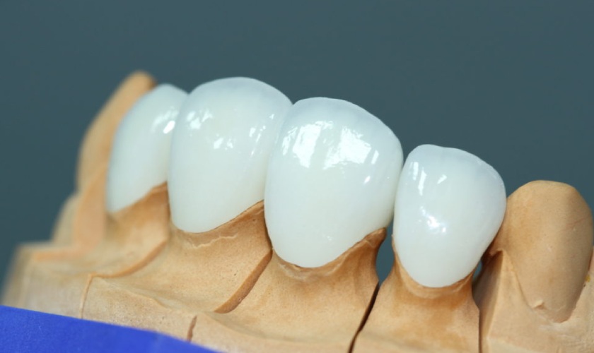 Răng sứ mang lại vẻ đẹp thẩm mỹ cho khách hàng Răng sứ mang lại vẻ đẹp thẩm mỹ cho khách hàng