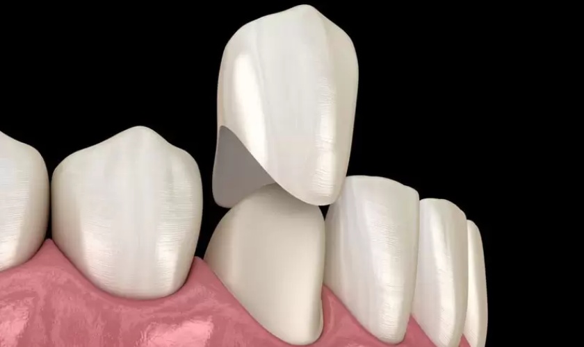 Chụp răng sứ có chi phí phù hợp Chụp răng sứ có chi phí phù hợp