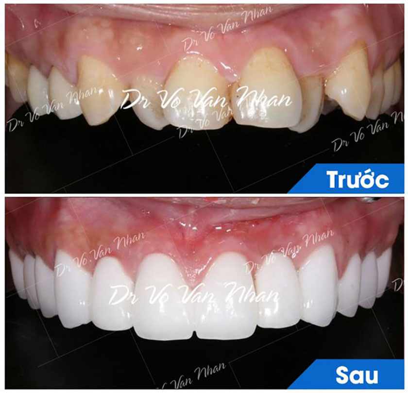 Hình ảnh khách hàng điều trị răng sứ thẩm mỹ tại Nha khoa Nhân Tâm
