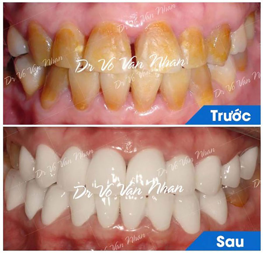 Hình ảnh khách hàng điều trị răng sứ thẩm mỹ tại Nha khoa Nhân Tâm