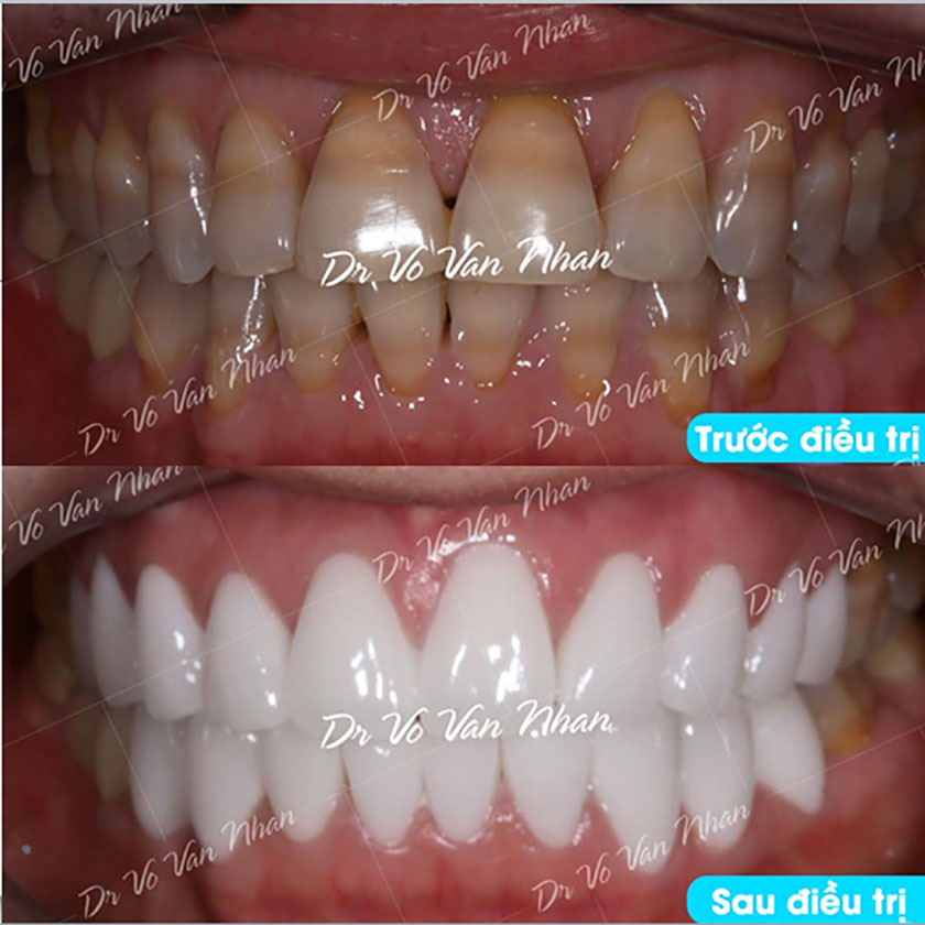 Khách hàng điều trị răng sứ thẩm mỹ tại Nha khoa Nhân Tâm