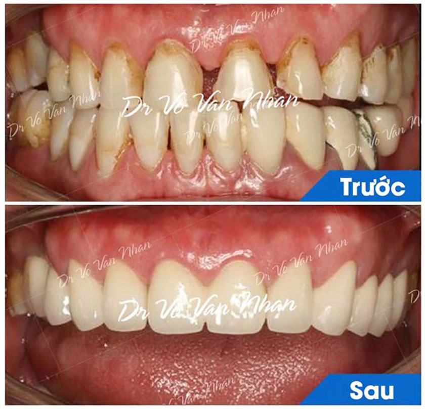 Hình ảnh khách hàng điều trị răng sứ thẩm mỹ tại Nha khoa Nhân Tâm