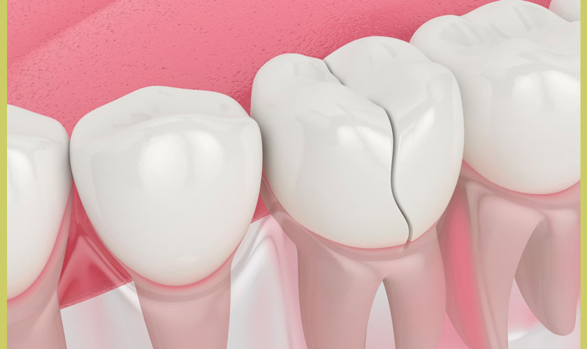 Răng sứ bị nứt cần tháo để phục hình lại