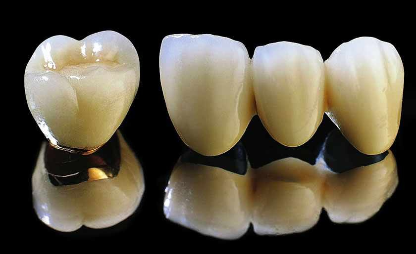 Quy trình bọc răng sứ titan có khó không