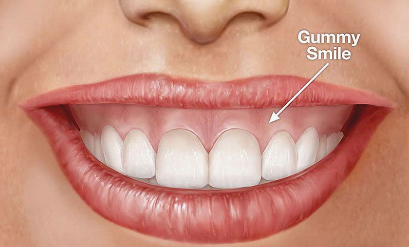 Tái tạo gai nướu trong phục hình sứ