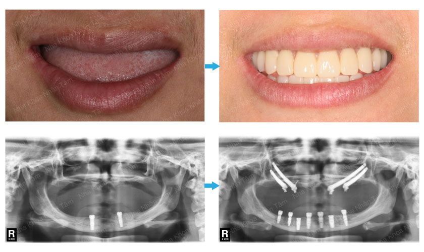 Khách hàng trước và sau khi trồng răng sứ tại nha khoa Nhân Tâm
