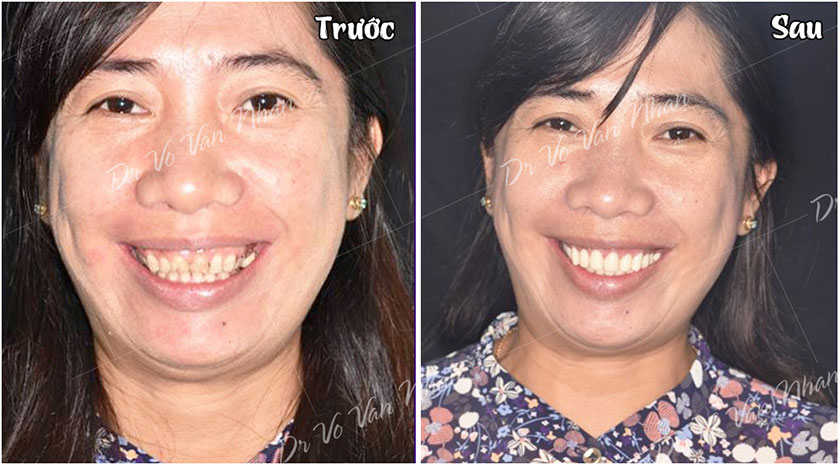 Răng sứ thẩm mỹ mang lại một hàm răng đều đẹp, trắng sáng tự nhiên