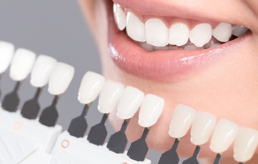 Răng sứ Veneer đem lại hiệu quả thẩm mỹ cao vượt trội