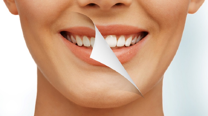 Cần lưu ý gì sau khi dán Veneer?