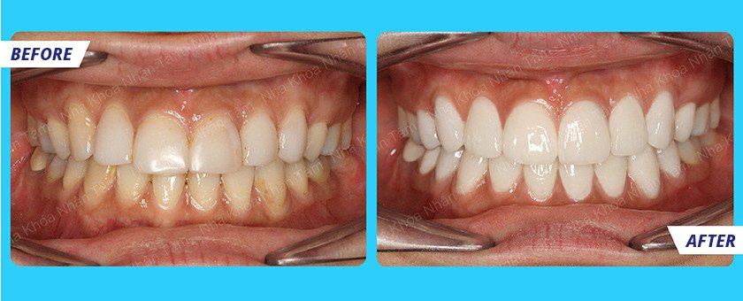 Kết quả sau khi bọc răng sứ tại nha khoa Nhân Tâm