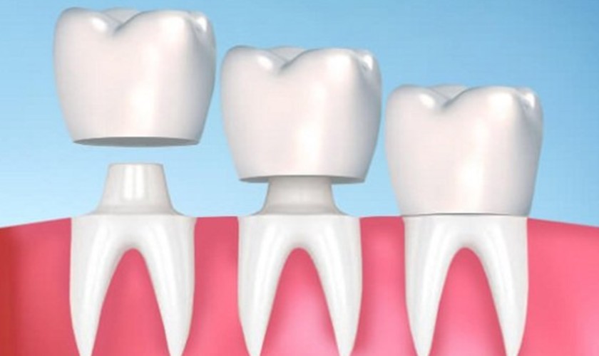 Kỹ thuật phục hình răng bọc sứ