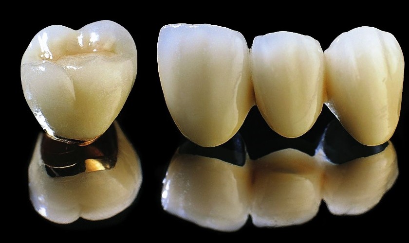 Răng bọc sứ cao cấp tại nha khoa Nhân Tâm