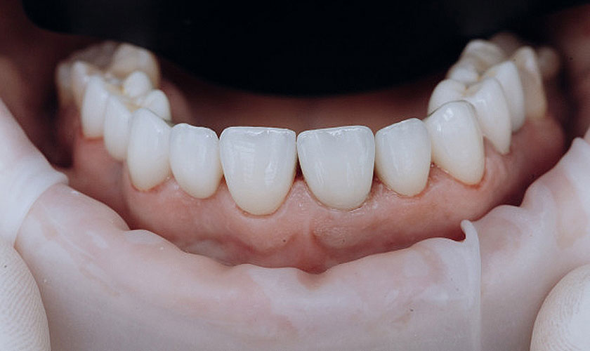 Ưu điểm của răng sứ Zirconia so với răng sứ Titan?
