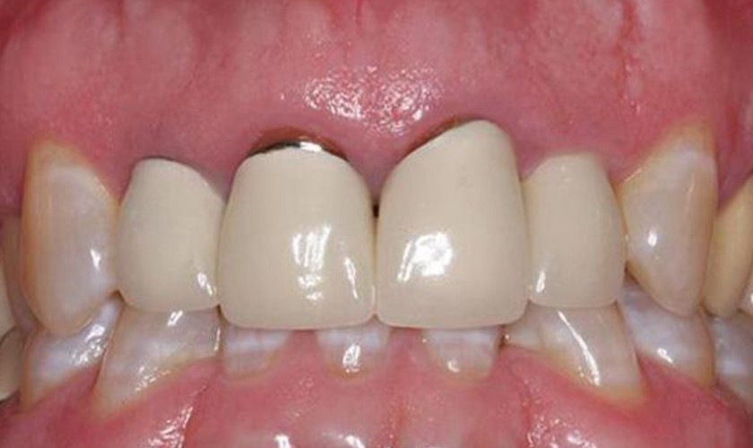 Răng sứ bị hở là lỗi kỹ thuật thường xảy ra sau khi bọc răng