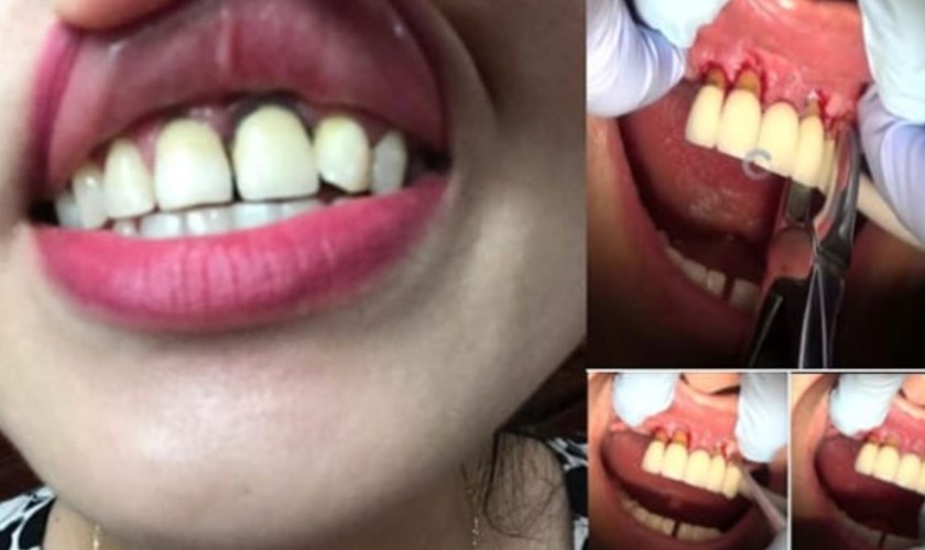 Răng sứ bị hở rất dễ khắc phục