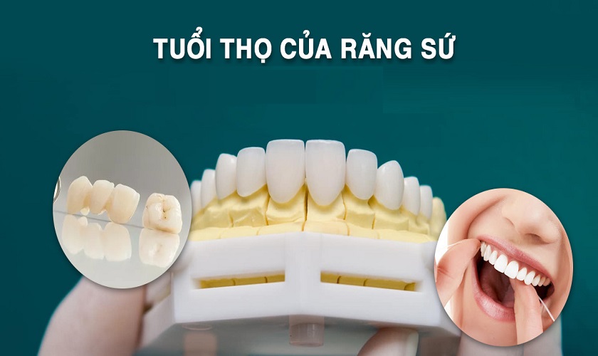 4. Khi nào cần thay răng sứ mới?