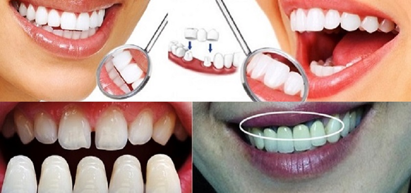 Bọc răng sứ bị hôi miệng – nguyên nhân do đâu?