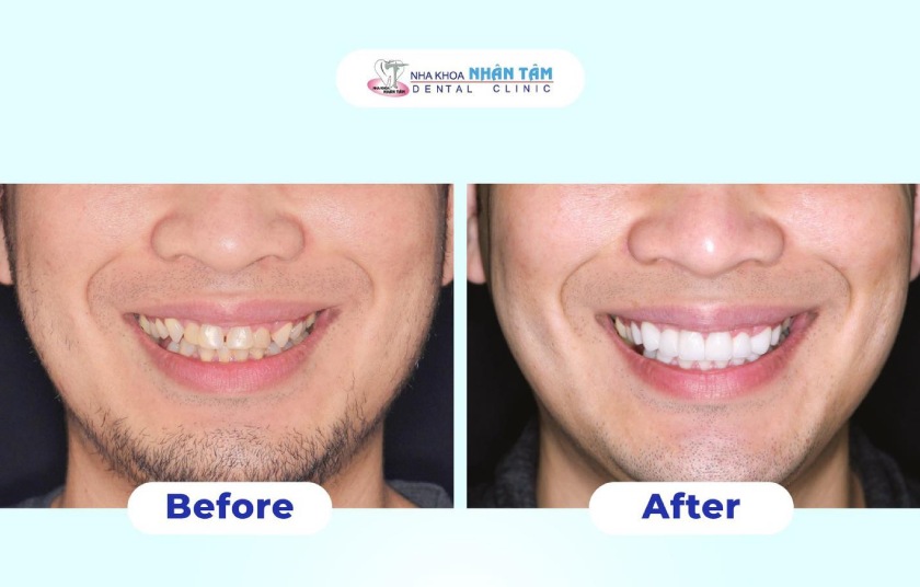 Khách hàng bọc răng sứ tại Nha khoa Nhân Tâm