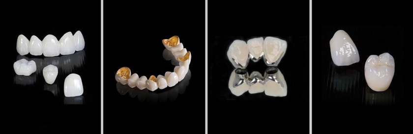 Các loại răng sứ hiện nay