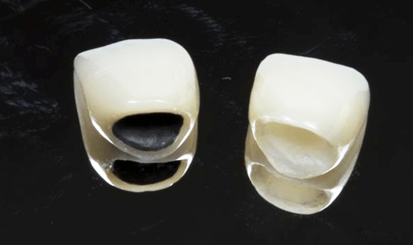 Răng sứ kim loại có chi phí thấp hơn so với răng toàn sứ