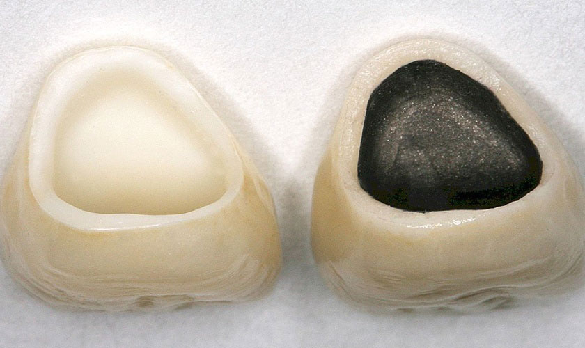 Răng sứ Mỹ có độ bền, thẩm mỹ không bằng răng toàn sứ