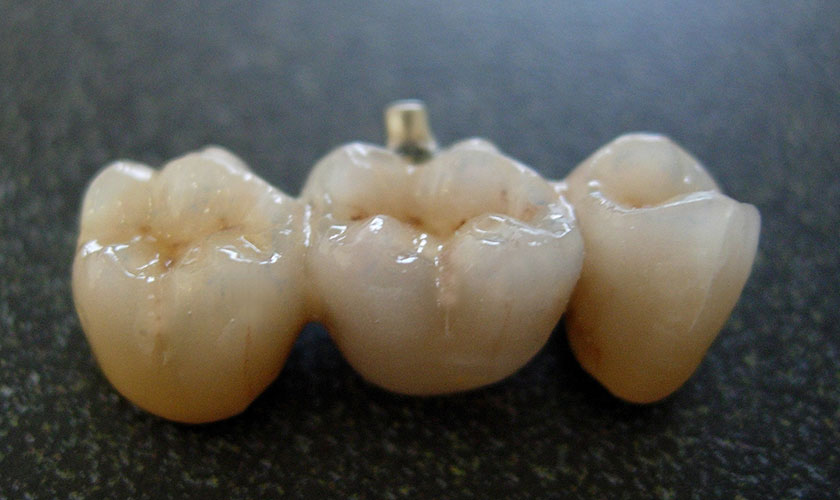 Nên bọc răng sứ loại nào khách hàng cần cân nhắc những ưu điểm và nhược điểm của các loại bọc răng sứ