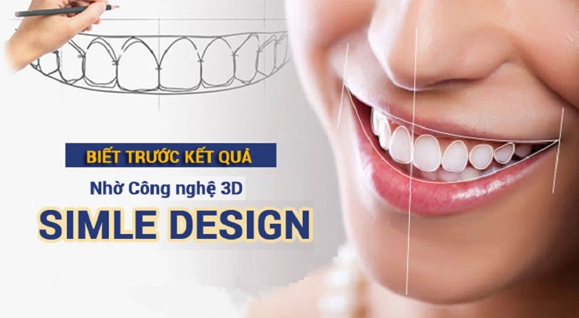 Công nghệ Smile Design giúp phân tích và thiết kế nụ cười hoàn hảo