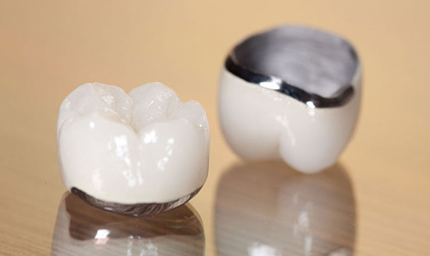 Bọc răng sứ Titan được khá nhiều người lựa chọn