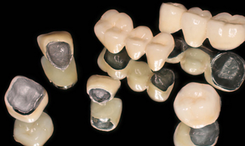 Răng sứ titan sở hữu nhiều ưu điểm vượt trội