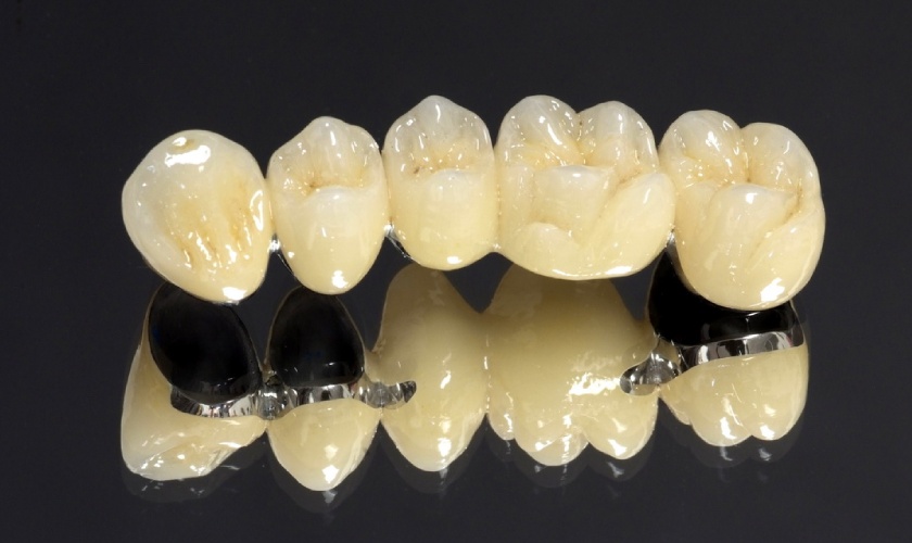 Giá bọc răng sứ titan còn tùy thuộc vào nhiều yếu tố